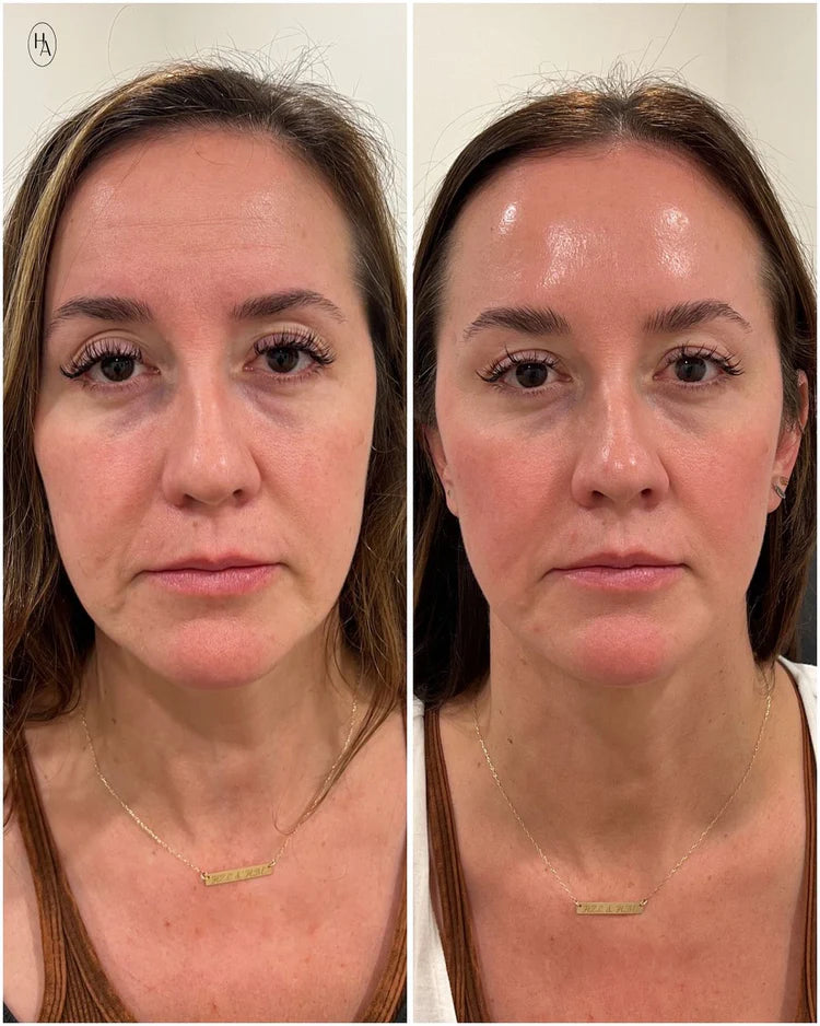 Belorra® Rice Peeling Serum