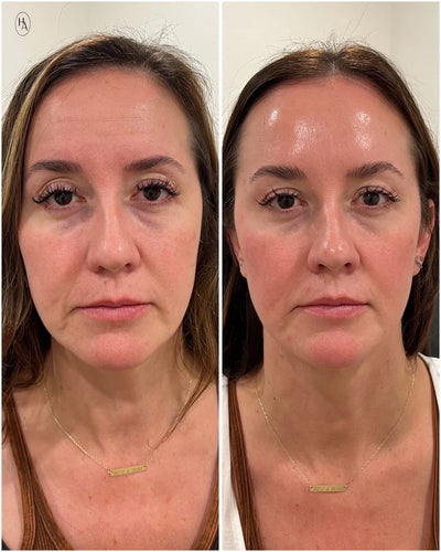 Belorra® Rice Peeling Serum