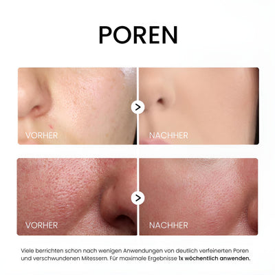 Belorra® Rice Peeling Serum